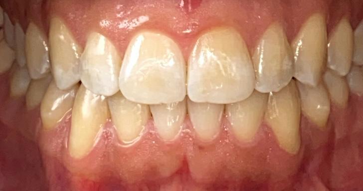 Après traitement Invisalign