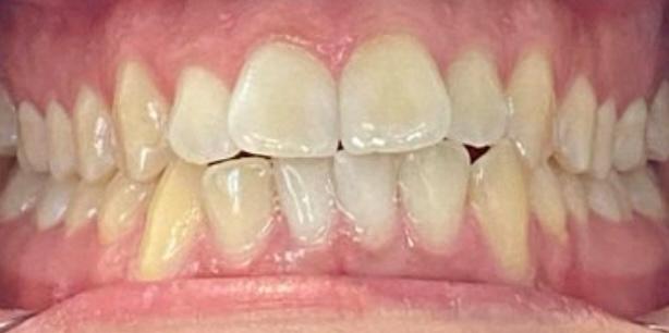 Avant traitement Invisalign