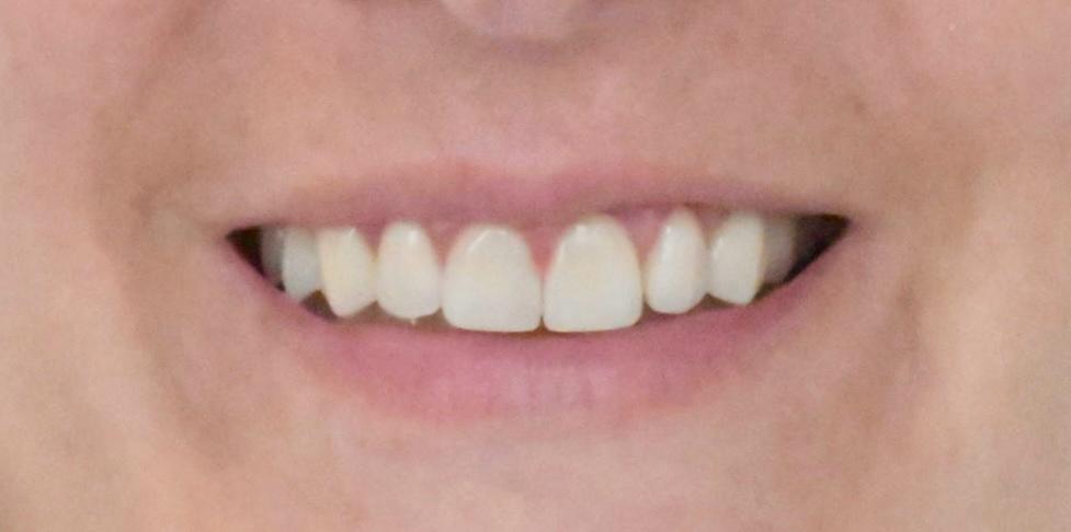 Après — réhabilitation, sourire restauré
