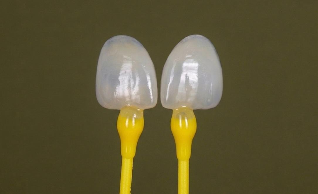Facettes dentaires : tout ce que vous devez savoir avant de vous lancer