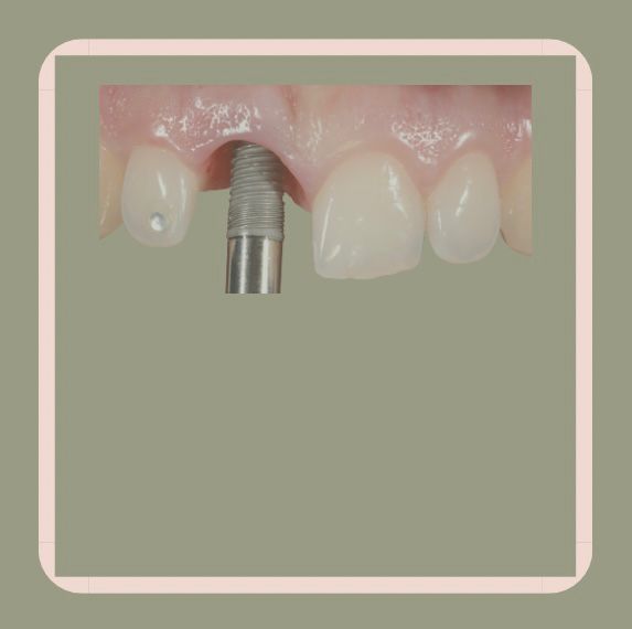 Implants dentaires