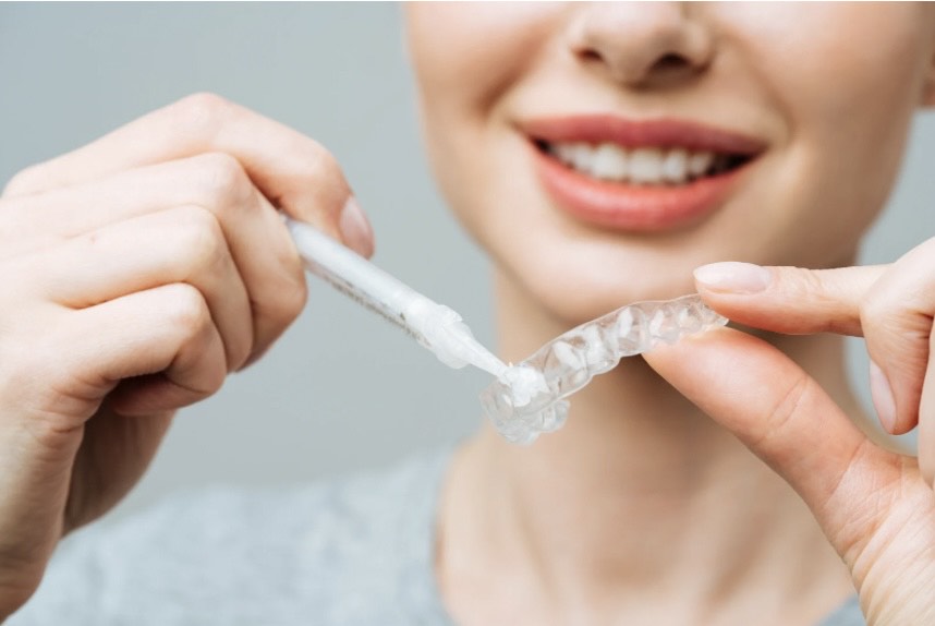 Application du gel de blanchiment dans une gouttière dentaire sur-mesure transparente