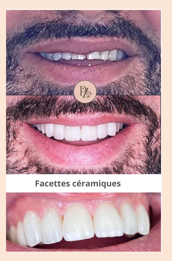 Avant après d'une réhabilitation par facettes céramiques au cabinet du Dr Précilia Ziri, Paris 9 Opéra