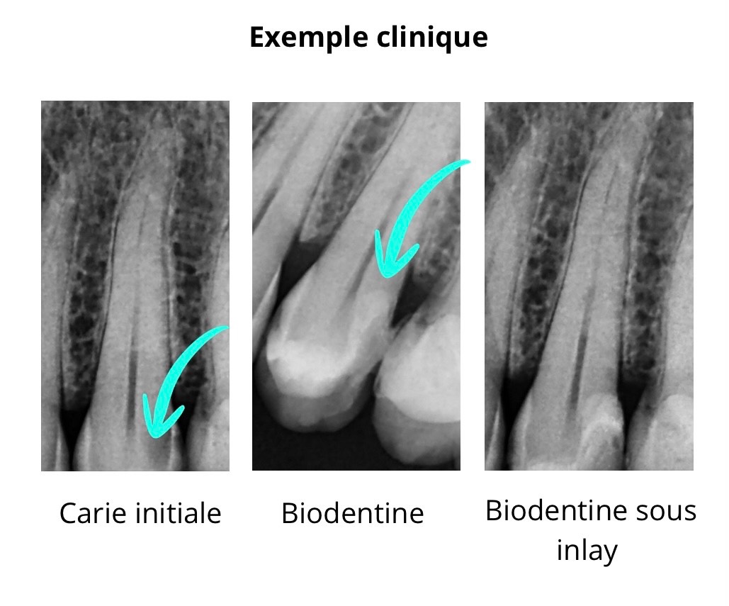 Radiographies d'un cas clinique : carie initiale, pose de Biodentine, puis Biodentine sous inlay - cabinet du Dr Précilia Ziri, Paris 9 Opéra