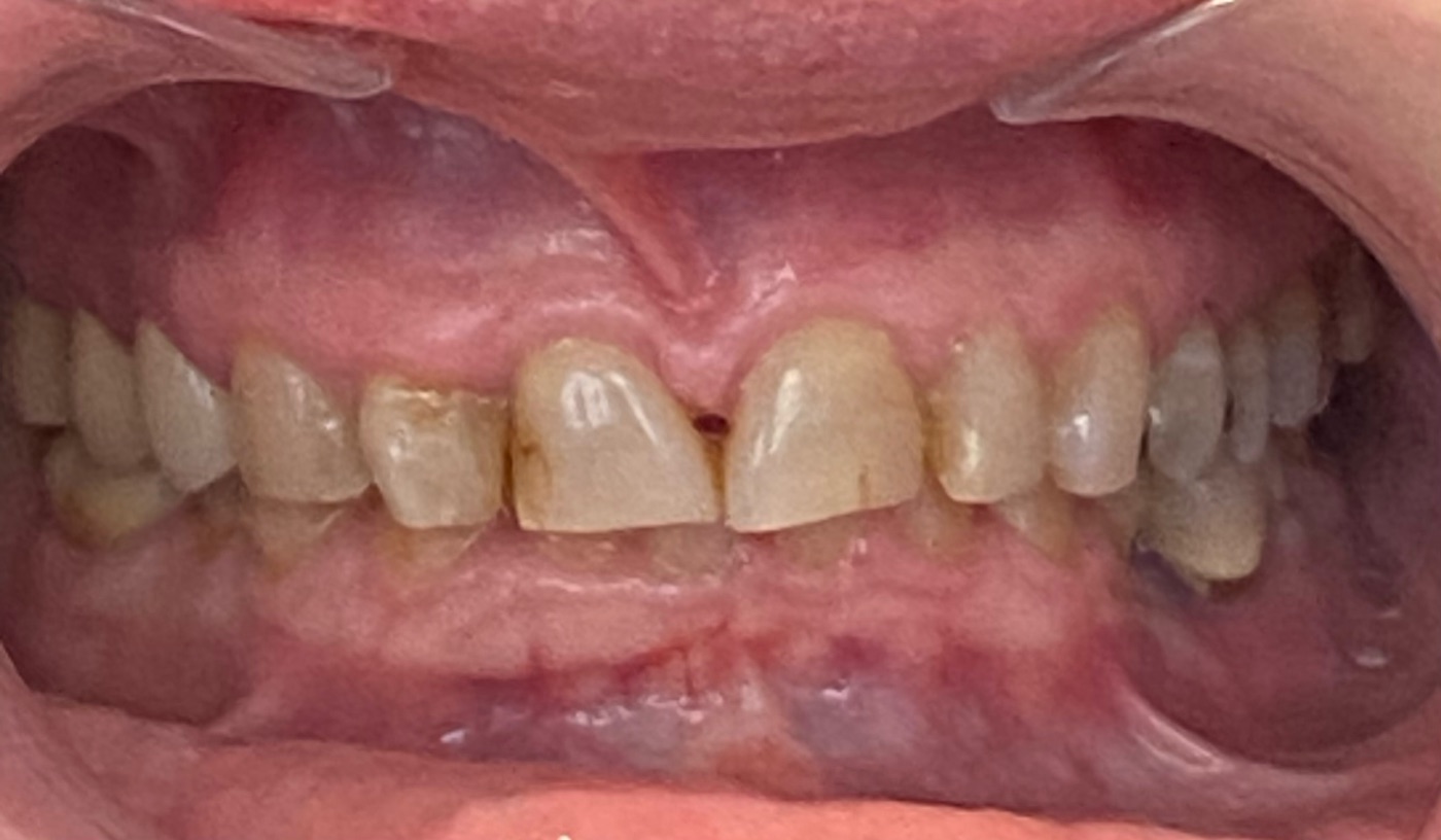 Usure généralisée des dents liée au bruxisme, avant traitement, au cabinet du Dr Précilia Ziri à Paris 9e Opéra