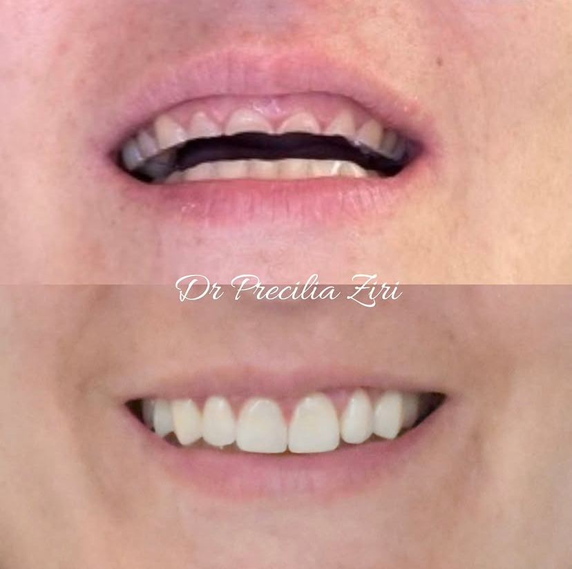 Avant et après une gingivoplastie modérée pour corriger un sourire gingival, cabinet du Dr Précilia Ziri, Paris 9e Opéra